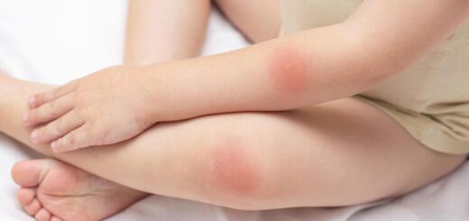 How is a rash in babies treated