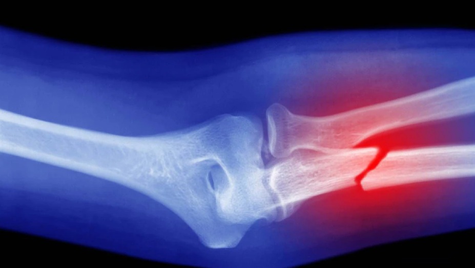 Foods that help prevent osteoporosis