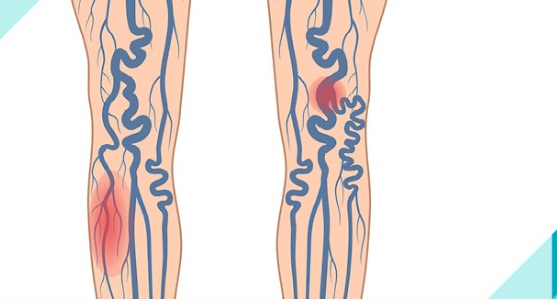 Thrombophlebitis