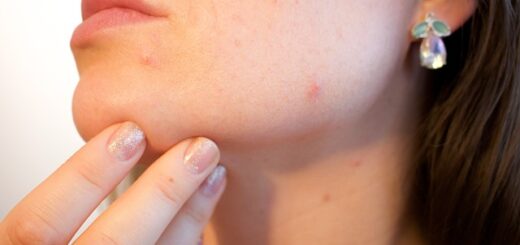 How to Get Rid of a Pimple on the Lip