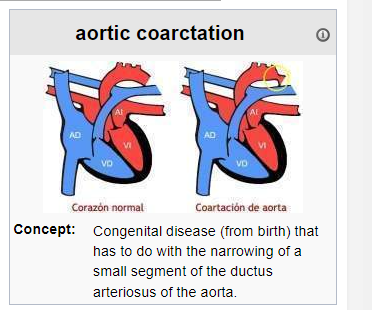 Aortic coarctation