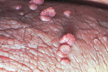 Genital Warts from Human Papillomavirus